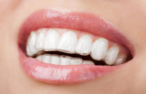 What is Invisalign scaled